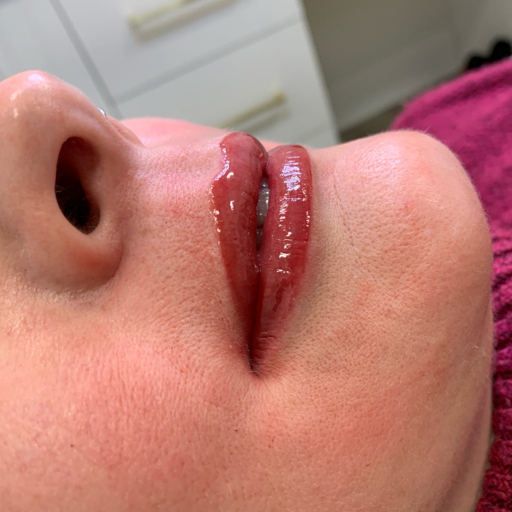 CleftLip_After2