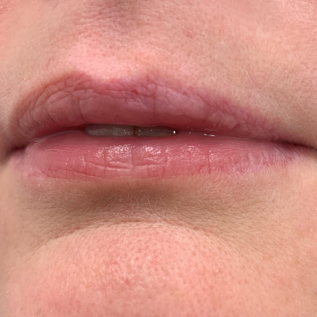 CleftLip_BEFORE1
