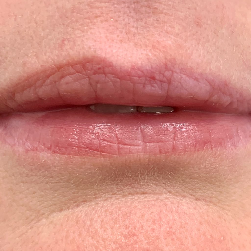CleftLip_BEFORE2