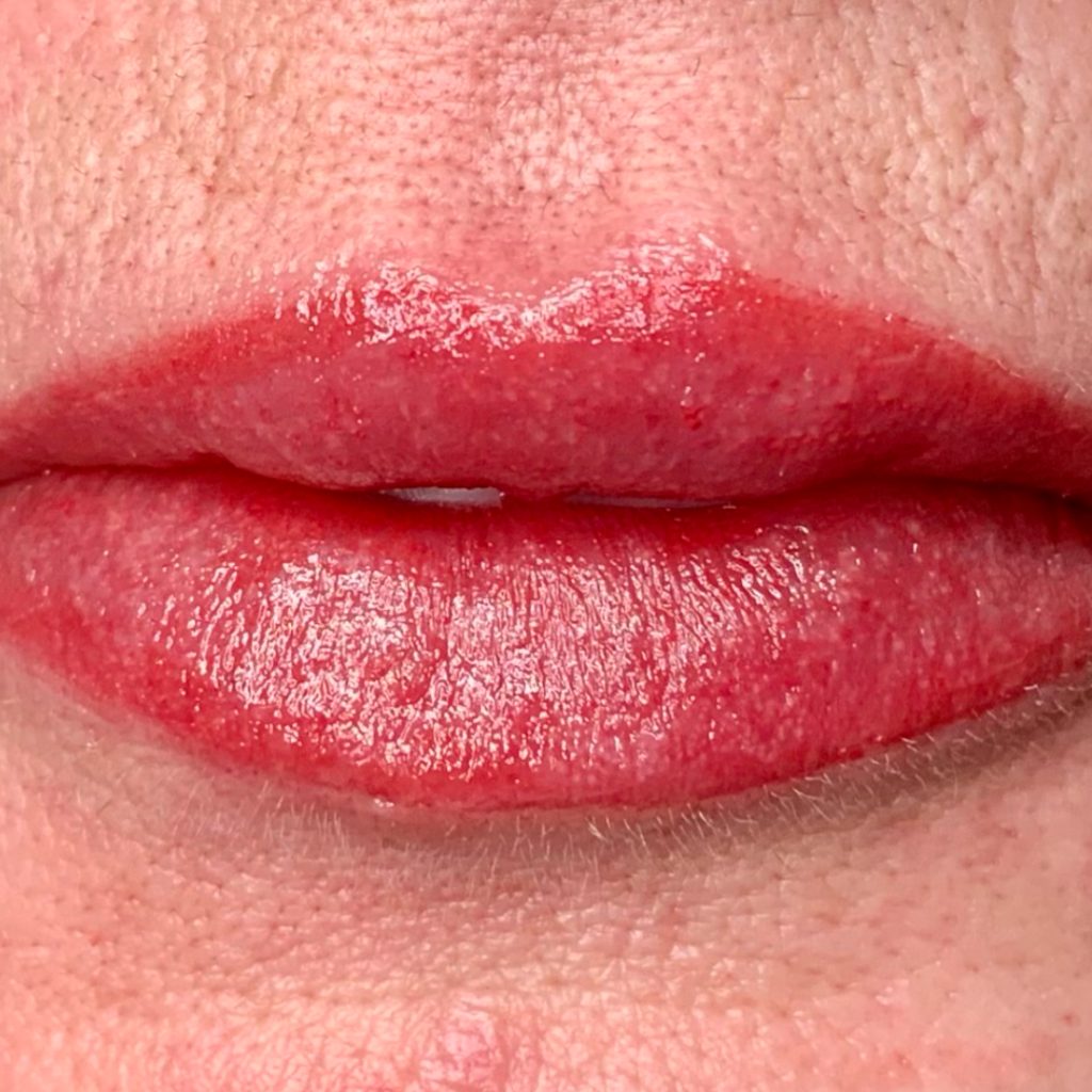 Lip Asym_AFTER
