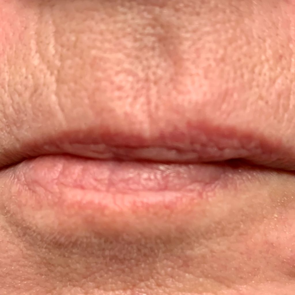 Lip Asym_BEFORE1