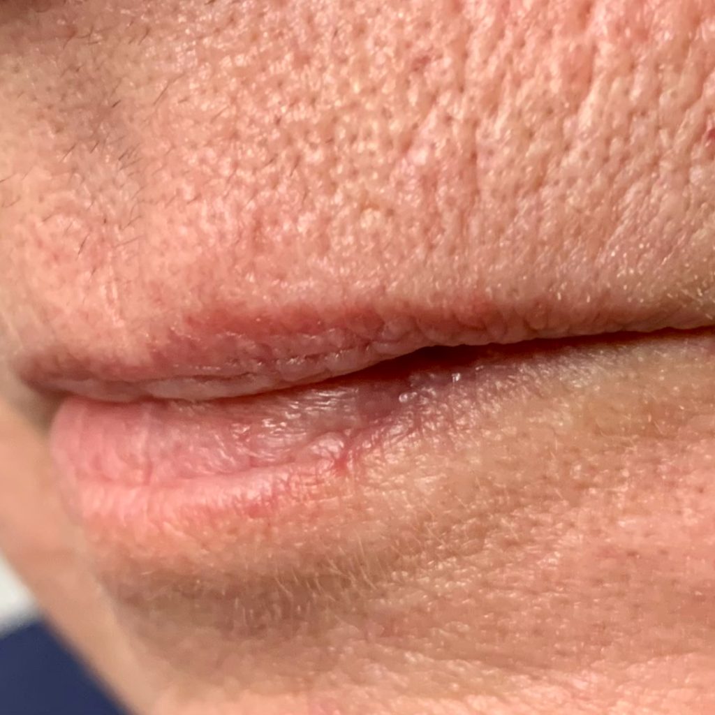 Lip Asym_BEFORE2