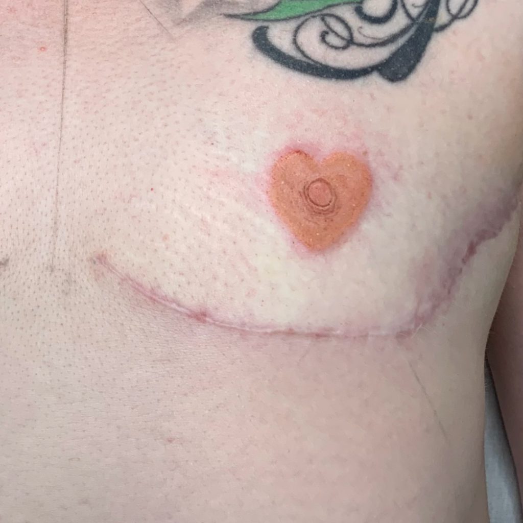 TransGenHeart_AFTER