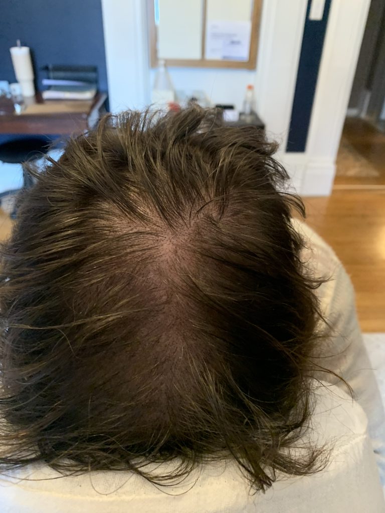 Alopecia_SMP_AFTER(1)