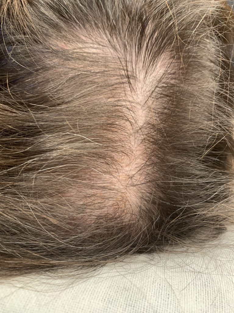 Alopecia_SMP_BEFORE(1)