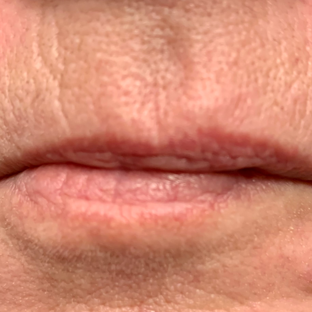 Lip Asym_BEFORE1