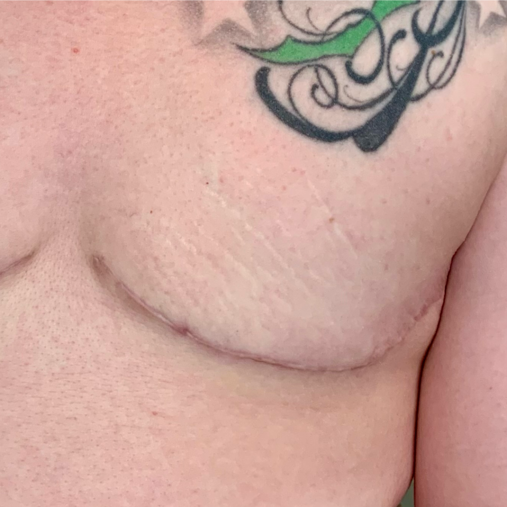 TransGenHeart_BEFORE